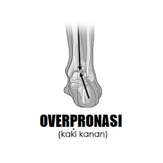 Overpronasi